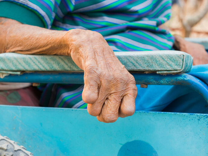 Leprosy patient rests arms on wheelchair