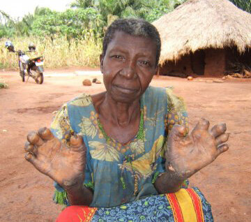 Leprosy Nnn